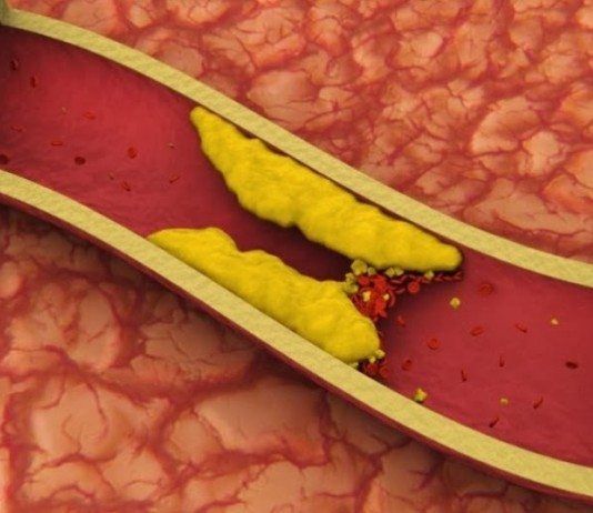 Hiperlipidemias o aumento de grasa en sangre hiperlipidemias
