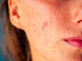 Nutrición y acné: lo que la dieta puede hacer por tu piel dieta acne