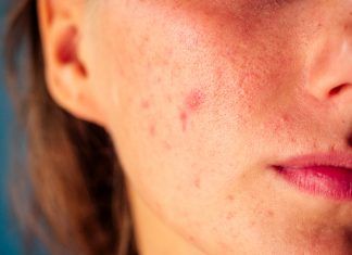 Nutrición y acné: lo que la dieta puede hacer por tu piel dieta acne